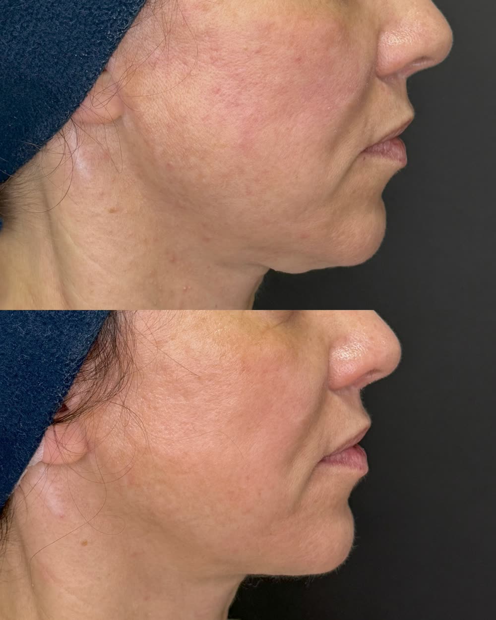 Antes e depois de um tratamento de face completa com Ultraformer MPT, em sessão única, com resultado após 45 dias