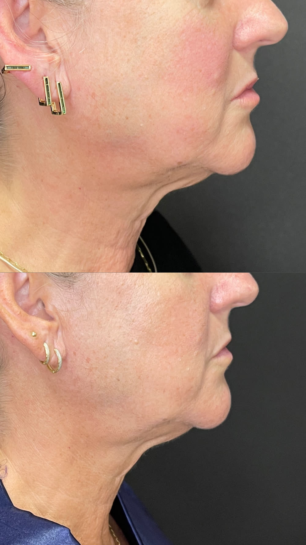 Antes e depois de um tratamento de papada e pescoço com Ultraformer MPT, em sessão única, com resultado após 45 dias