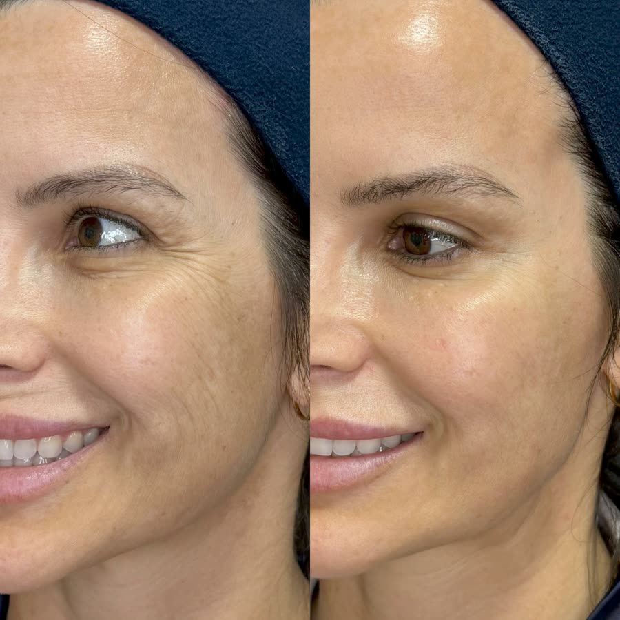 Antes e depois da região periorbital tratada com Ultraformer MPT