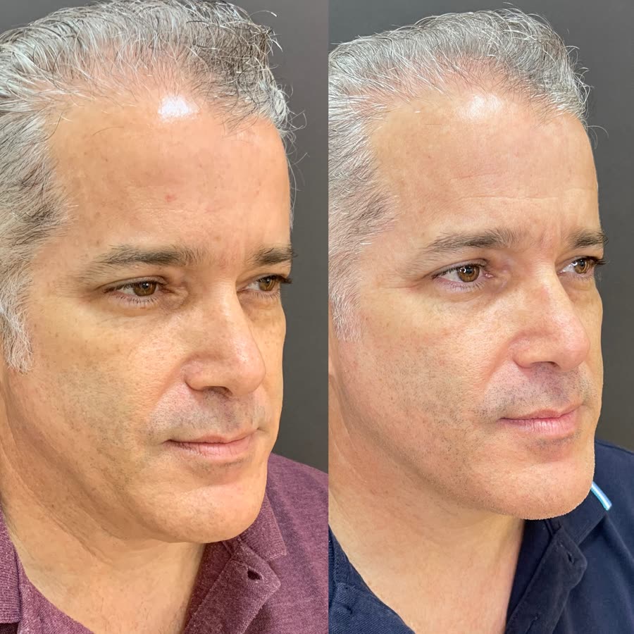 Antes e depois de paciente masculino tratado com Ultraformer MPT