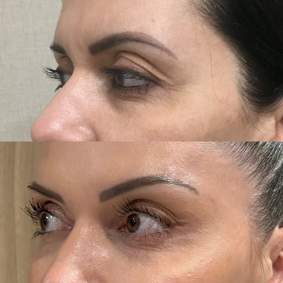 Resultado de longo prazo na região dos olhos com Ultraformer MPT, comparação ao longo de cinco anos