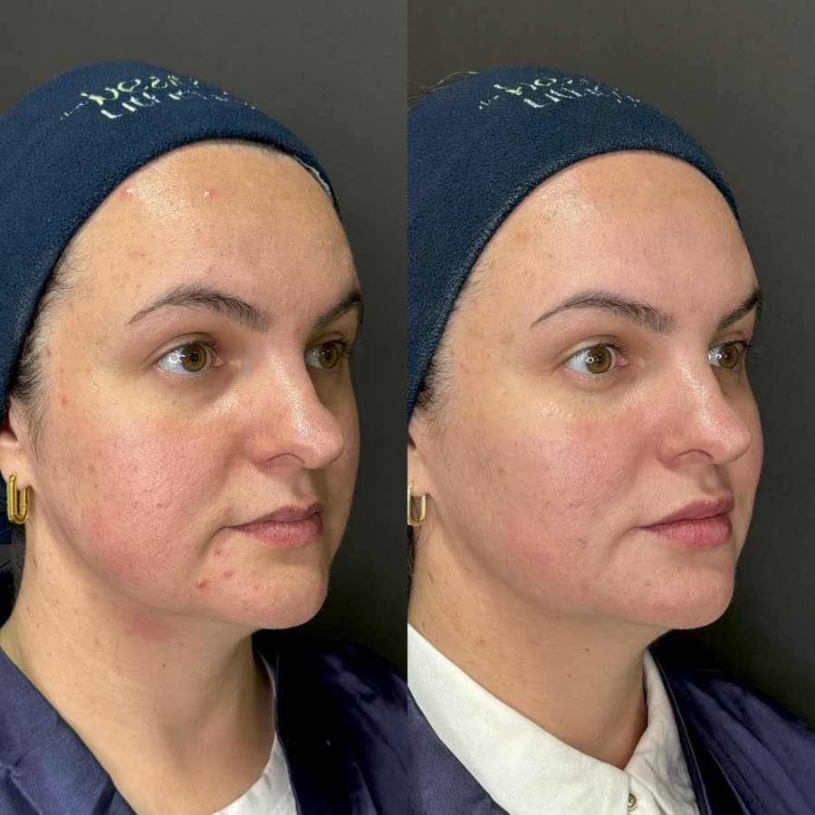 Antes e depois de bochechas e contorno tratados com Ultraformer MPT, resultado após 30 dias