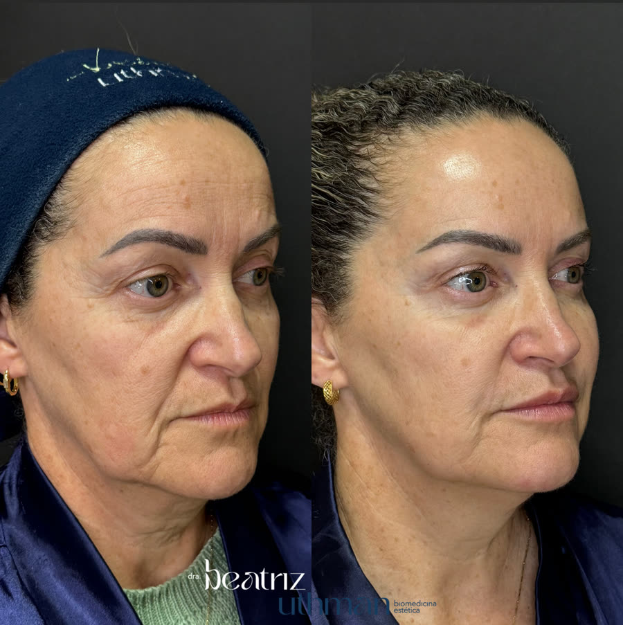 Antes e depois de protocolo Full Face com Lifting Temporal Tecnológico, resultado após 30 dias