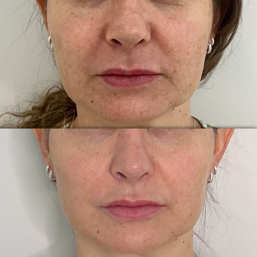 Antes e depois de face tratada por aluna do curso, 30 dias após