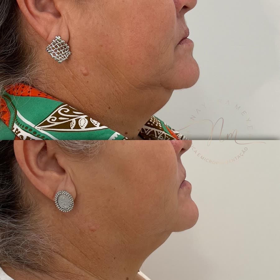 Antes e depois de pescoço de paciente tratada por aluna do curso, 30 dias após