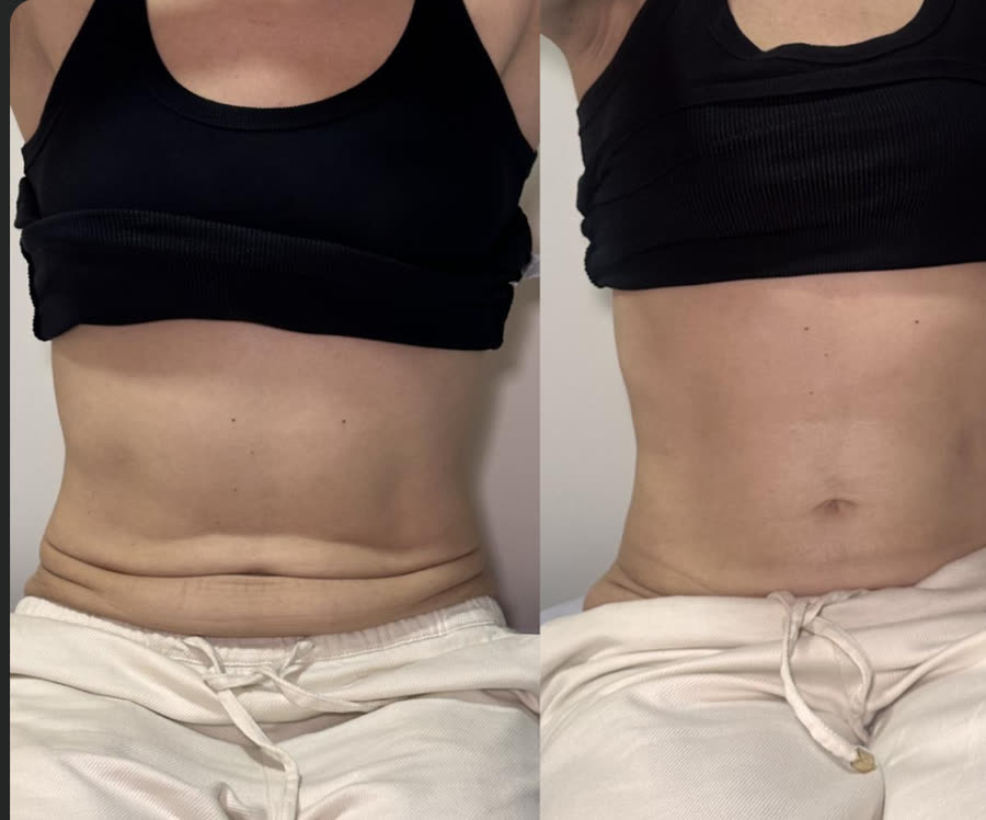 Antes e depois de abdome tratado por aluna do curso com Ultraformer MPT