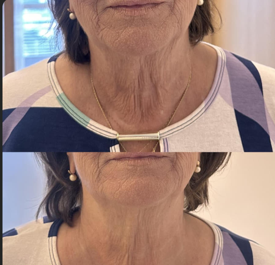 Antes e depois de pescoço tratado por aluna do curso com Ultraformer MPT